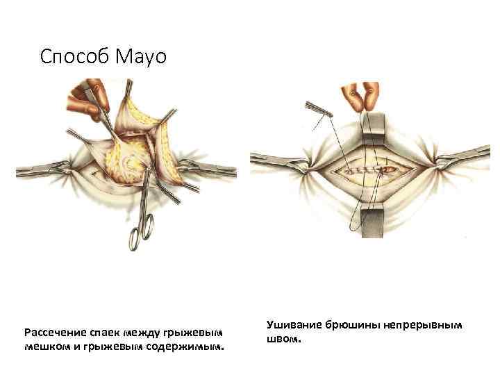  Способ Mayo    Ушивание брюшины непрерывным Рассечение спаек между грыжевым 