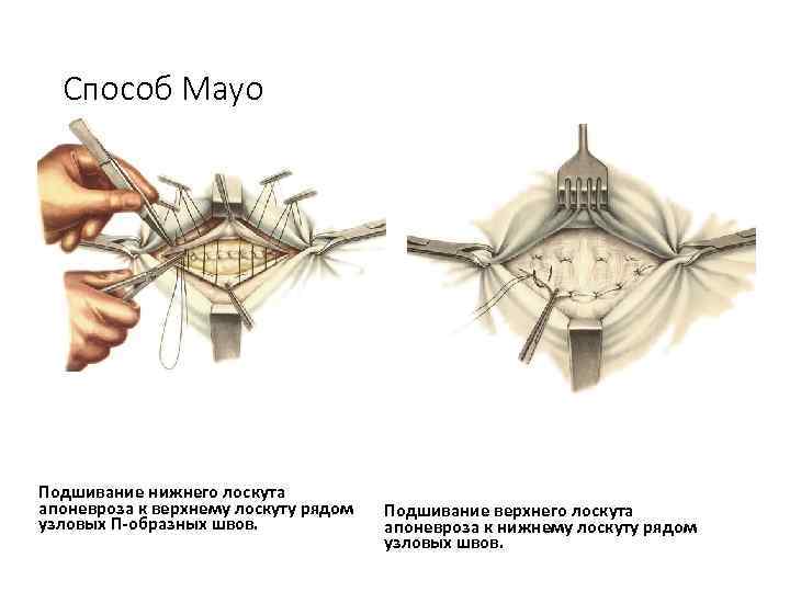  Способ Mayo Подшивание нижнего лоскута апоневроза к верхнему лоскуту рядом  Подшивание верхнего