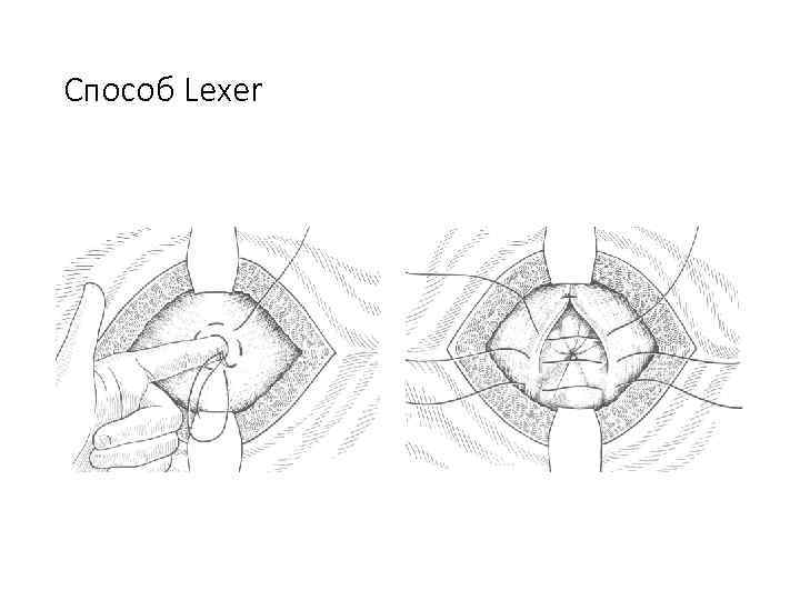 Способ Lexer 