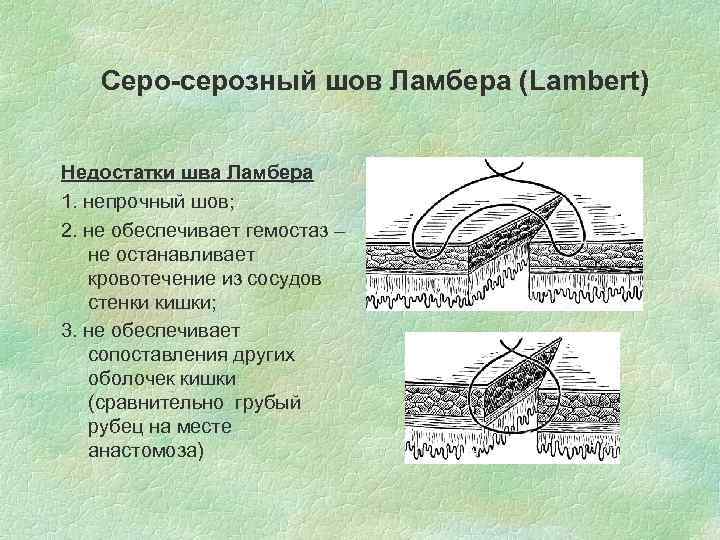   Серо-серозный шов Ламбера (Lambert)  Недостатки шва Ламбера 1. непрочный шов; 2.