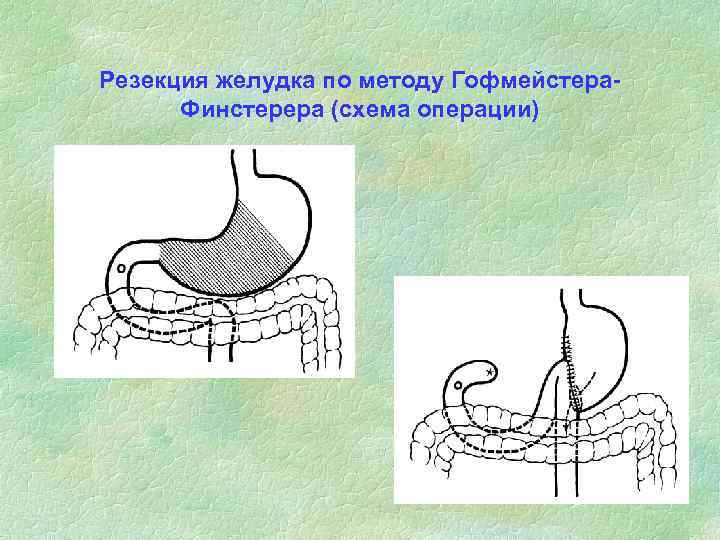 Резекция желудка по методу Гофмейстера-  Финстерера (схема операции) 