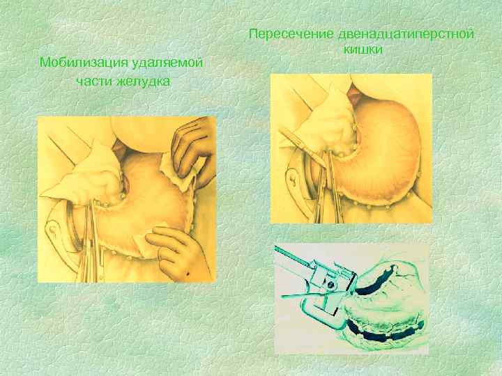     Пересечение двенадцатиперстной       кишки Мобилизация