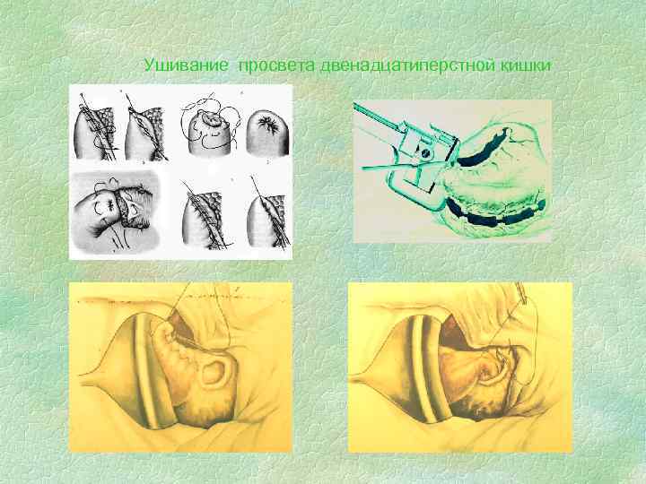 Ушивание просвета двенадцатиперстной кишки 
