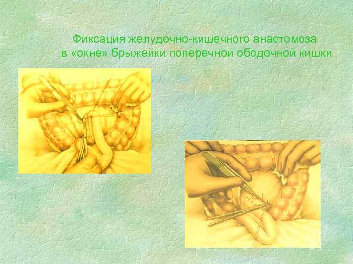  Фиксация желудочно-кишечного анастомоза в «окне» брыжейки поперечной ободочной кишки 