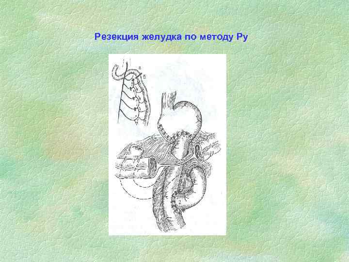Резекция желудка по методу Ру 