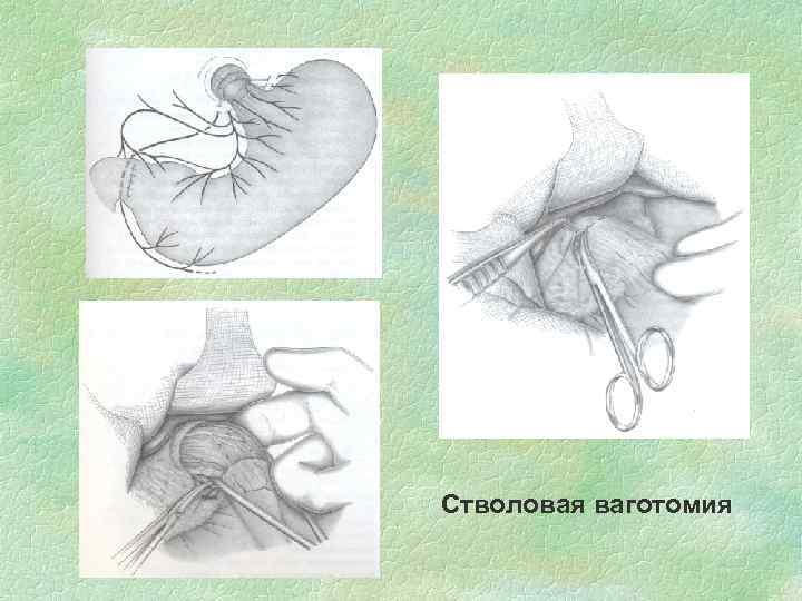 Стволовая ваготомия 