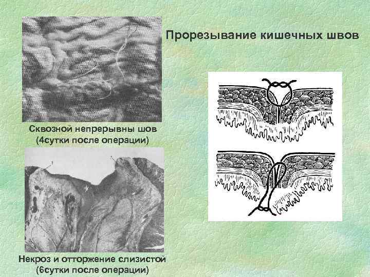       Прорезывание кишечных швов Сквозной непрерывны шов  (4
