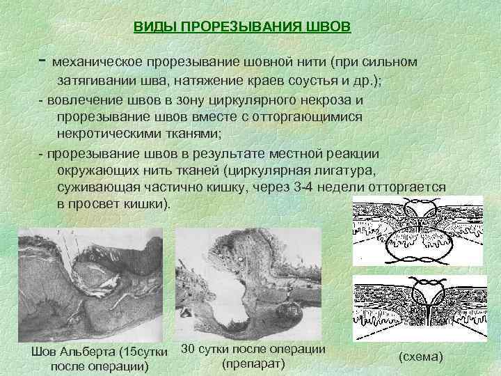     ВИДЫ ПРОРЕЗЫВАНИЯ ШВОВ  - механическое прорезывание шовной нити (при
