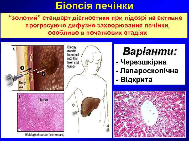     Біопсія печінки  “золотий” стандарт діагностики при підозрі на активне