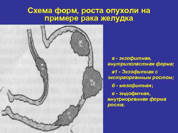 Схема форм, роста опухоли на  примере рака желудка    а -
