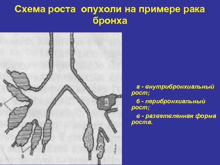 Схема роста опухоли на примере рака    бронха    