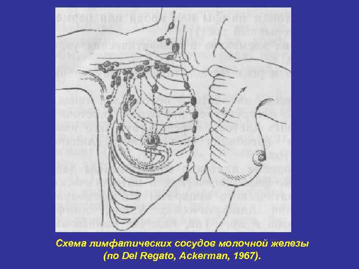 Схема лимфатических сосудов молочной железы   (по Del Regato, Ackerman, 1967). 