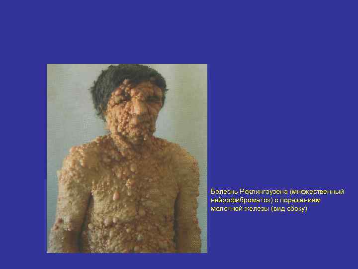 Болезнь Реклингаузена (множественный нейрофиброматоз) с поражением молочной железы (вид сбоку) 