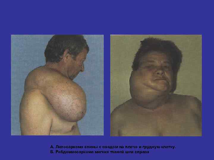 А. Липосаркома спины с входом на плечо и грудную клетку. Б. Рабдомиосаркома мягких тканей