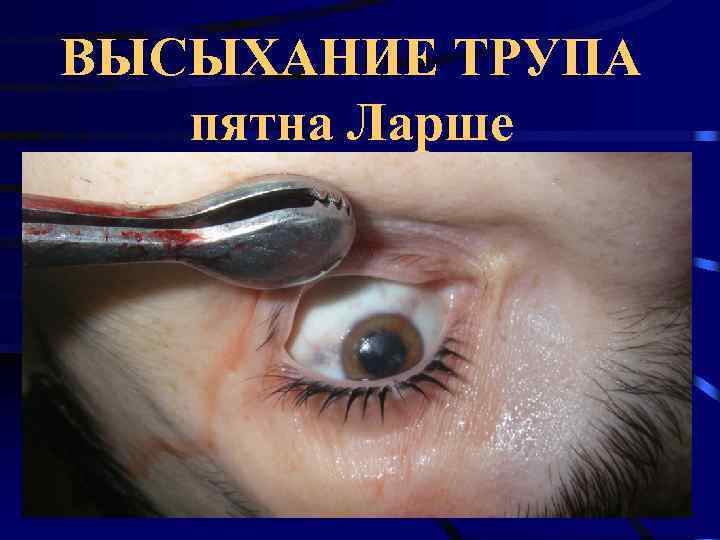 ВЫСЫХАНИЕ ТРУПА  пятна Ларше 