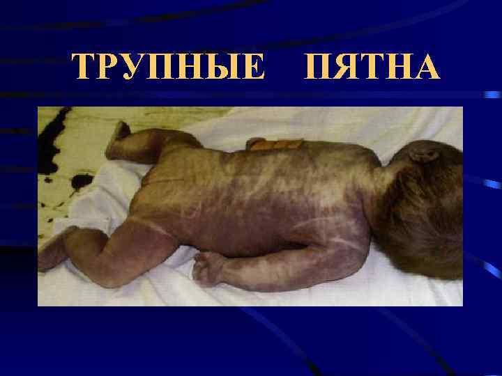 ТРУПНЫЕ ПЯТНА 