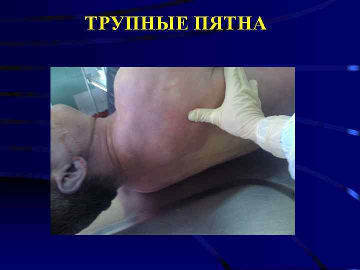 ТРУПНЫЕ ПЯТНА 