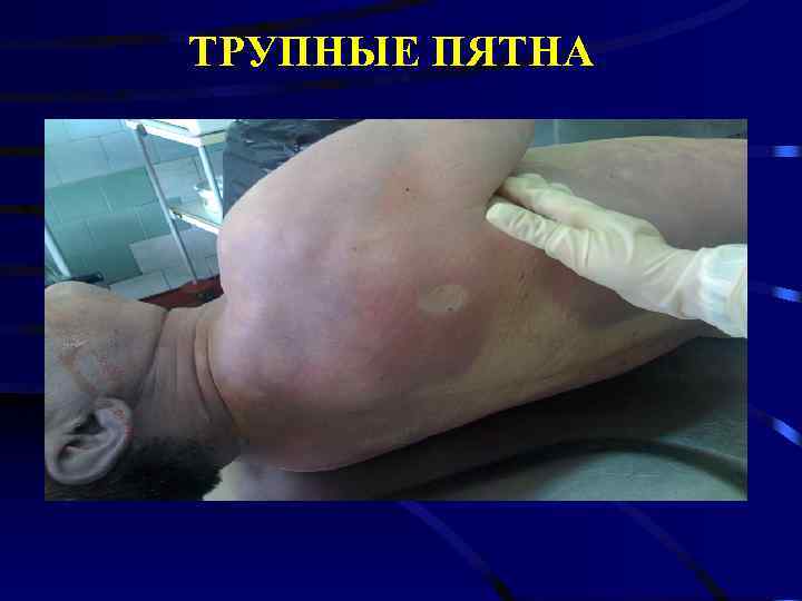 ТРУПНЫЕ ПЯТНА 