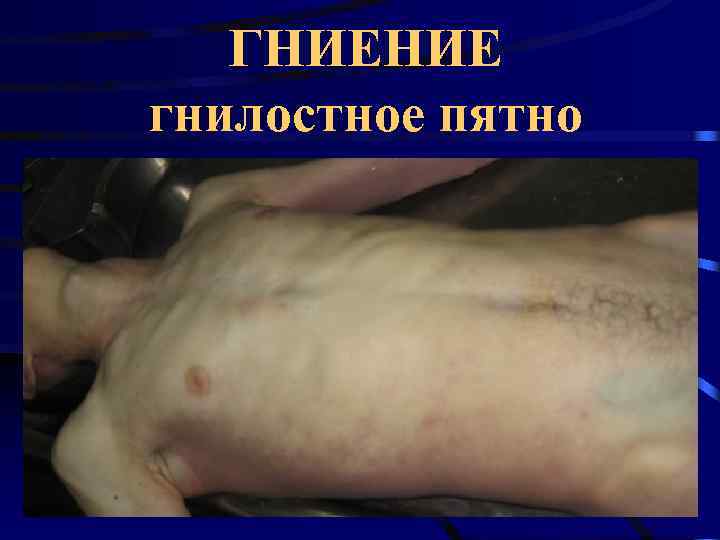   ГНИЕНИЕ гнилостное пятно 