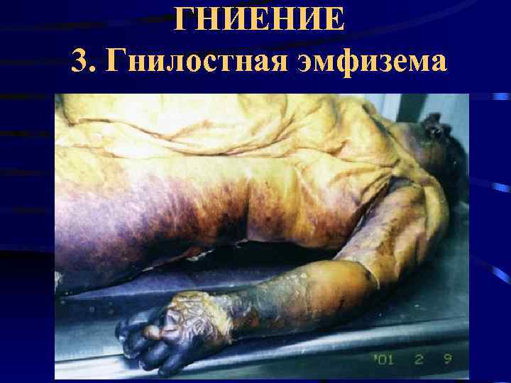  ГНИЕНИЕ 3. Гнилостная эмфизема 