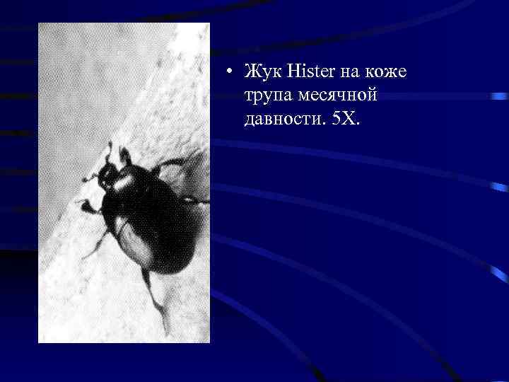  • Жук Hister на коже  трупа месячной  давности. 5 Х. 