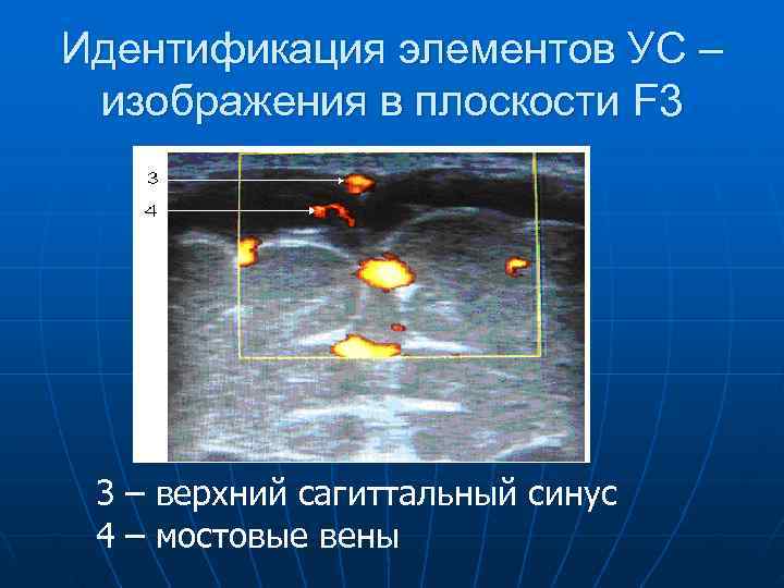 Идентификация элементов УС – изображения в плоскости F 3 3 – верхний сагиттальный синус