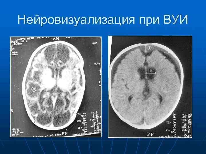 Нейровизуализация при ВУИ 