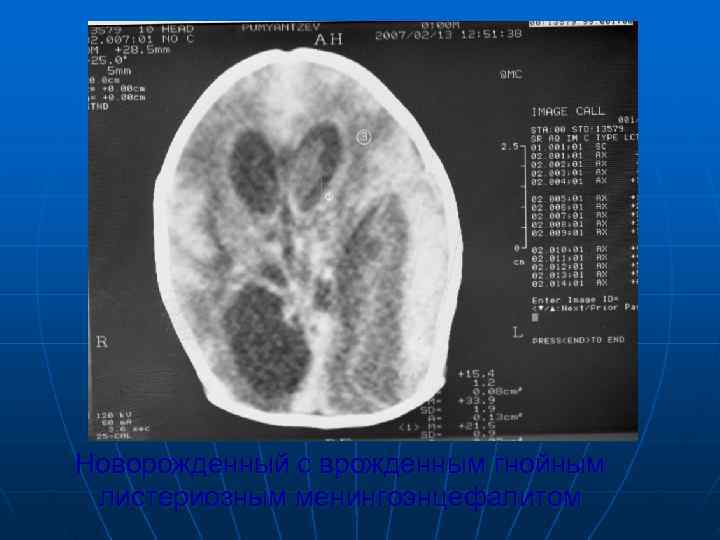 Новорожденный с врожденным гнойным листериозным менингоэнцефалитом 