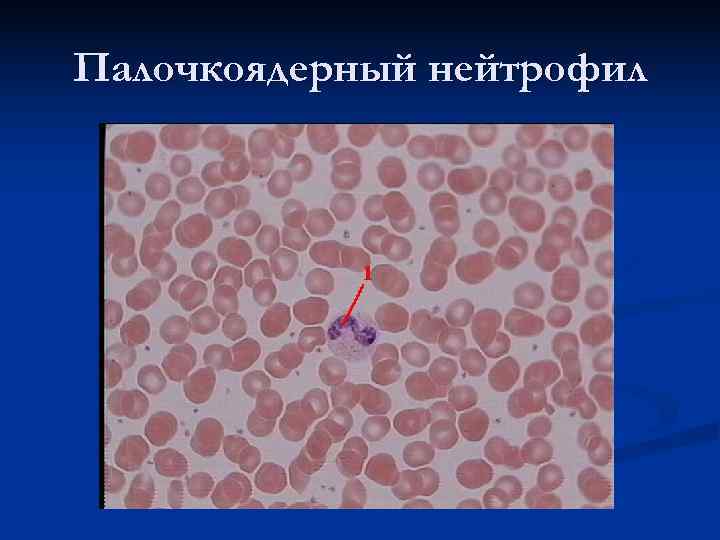 Палочкоядерный нейтрофил 
