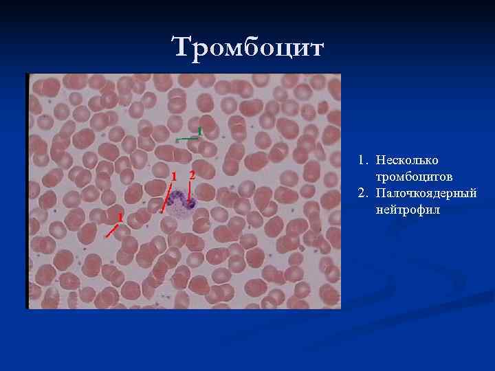 Тромбоцит    1. Несколько    тромбоцитов   2. Палочкоядерный
