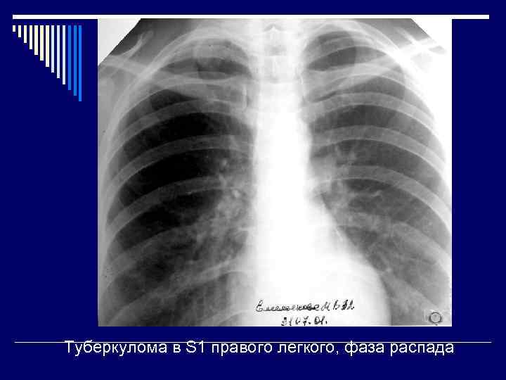 Туберкулома в S 1 правого легкого, фаза распада 