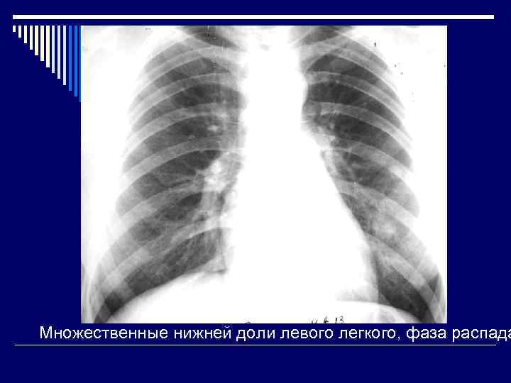 Образование в легких. Очаговый образования в легки. Образование в верхней доли левого легкого. Очаговые образования в легких. Очаговое образование в/доли легкого.