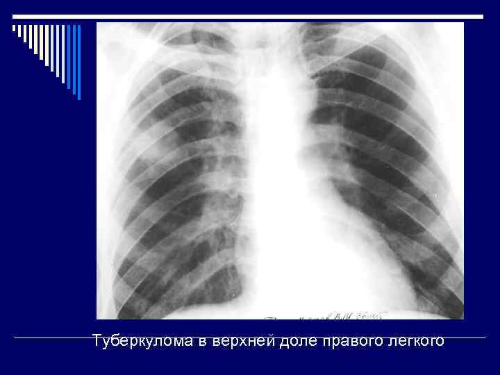 Туберкулома в верхней доле правого легкого 