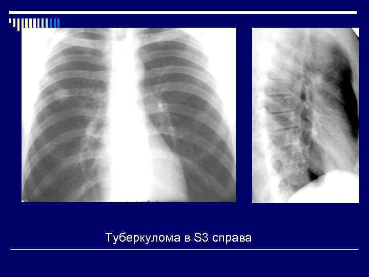 Солидное образование в легком. Очаговые образования в легких. Образование правого легкого. Образование в/д правого легкого.