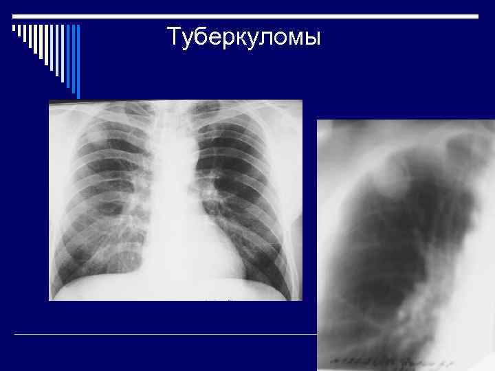 Легкие без очаговых теней