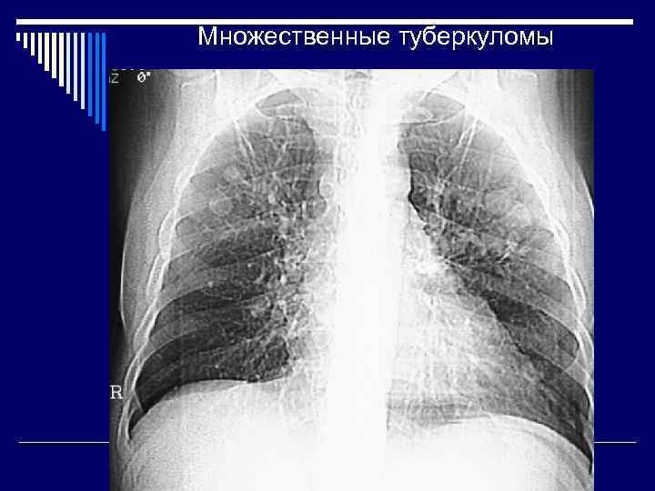 Множественные туберкуломы 