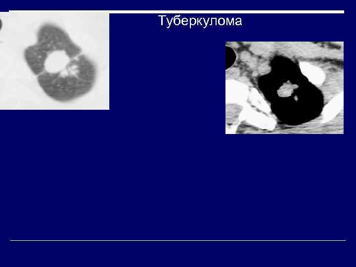 Туберкулома 
