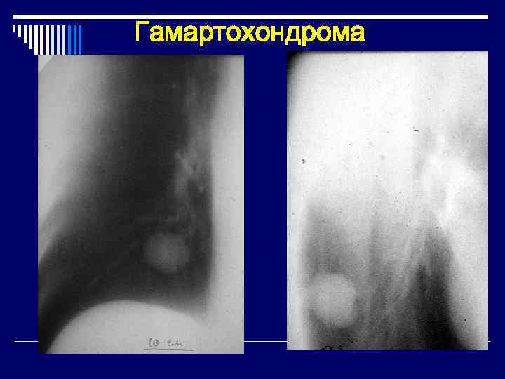 Гамартохондрома 