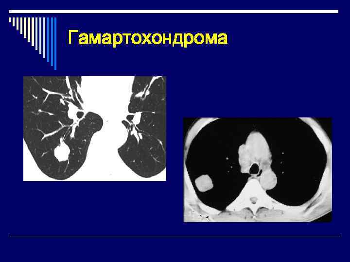 Гамартохондрома 