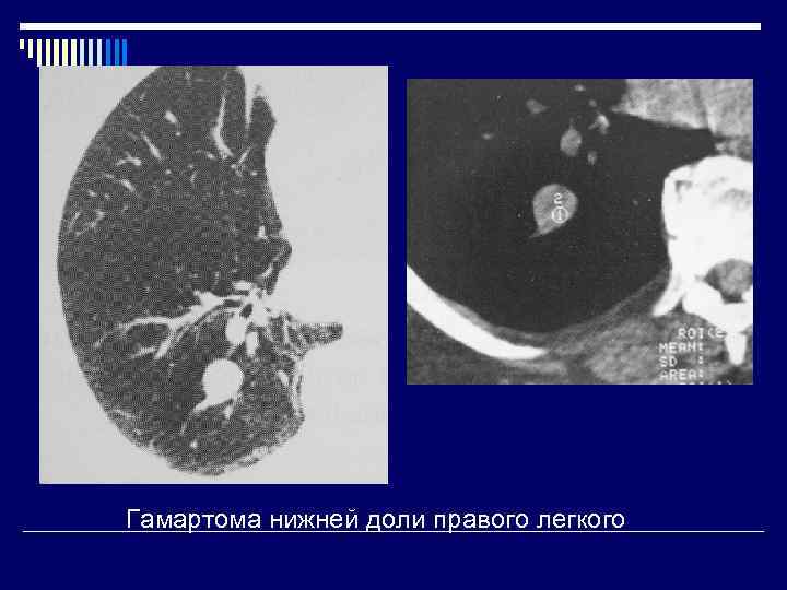 Гамартома нижней доли правого легкого 