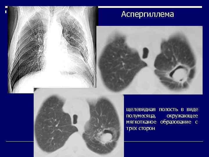 Аспергиллема щелевидная полость в виде полумесяца,  окружающее мягкотканое образование с трех сторон 