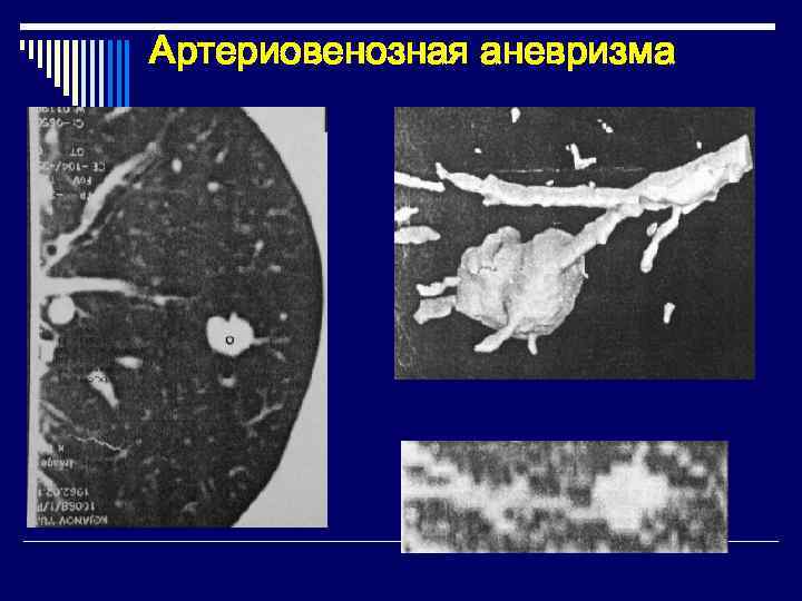 Очаговое образование. Сосудистая мальформация легких на кт. Очаговые образования в легких. Сосудистые мальформации в легких кт. Очаговое образование легкого на кт.