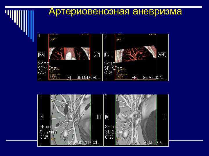 Артериовенозная аневризма 