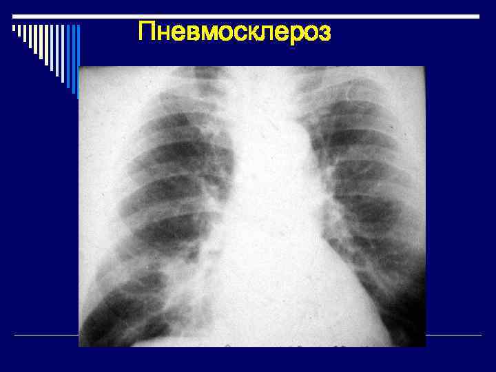 Пневмосклероз 