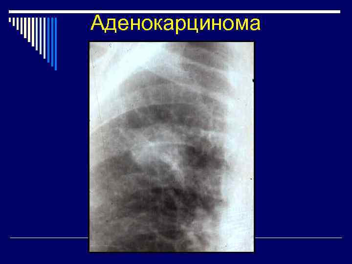 Аденокарцинома 