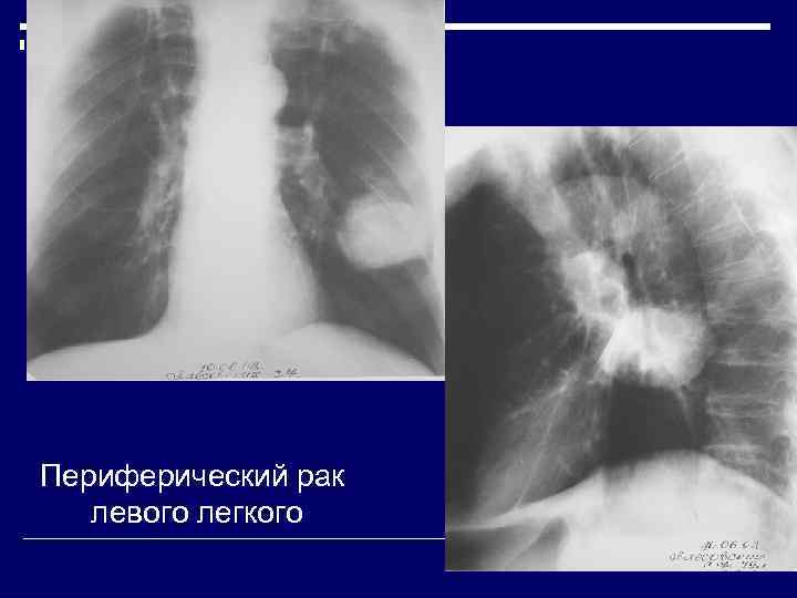 Образование в легком. Шаровидное образование в легком. Периферическое образование в легких что это. Периферическое очаговое образование левого легкого. Периферическое образование правого легкого.