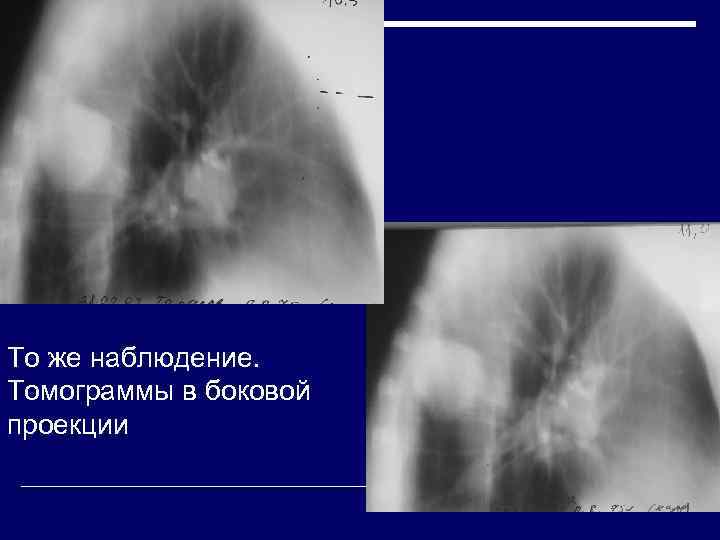 То же наблюдение.  Томограммы в боковой проекции 