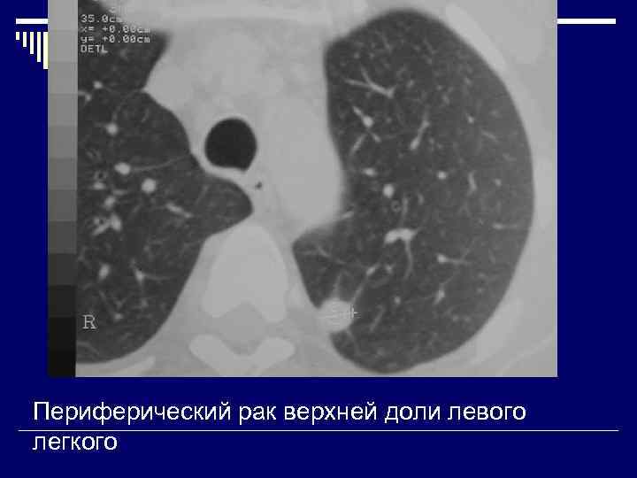 Периферический рак верхней доли левого легкого 