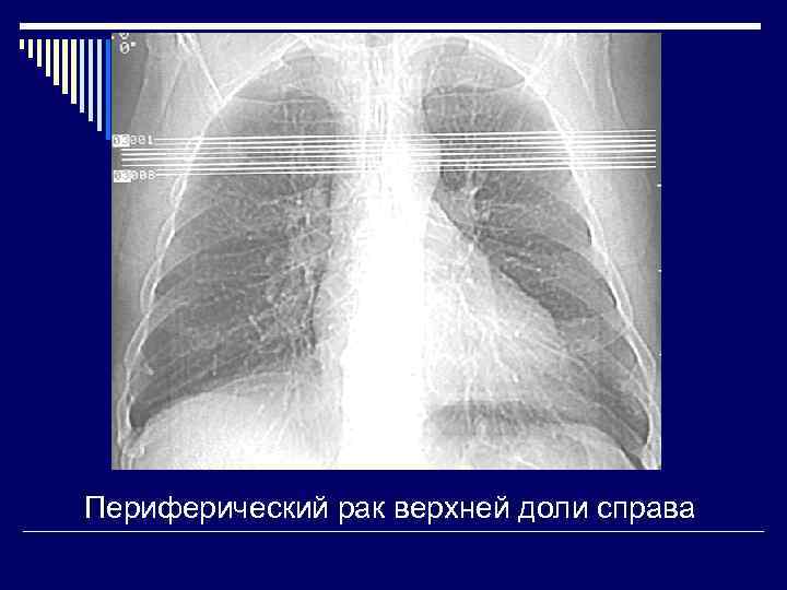 Периферический рак верхней доли справа 