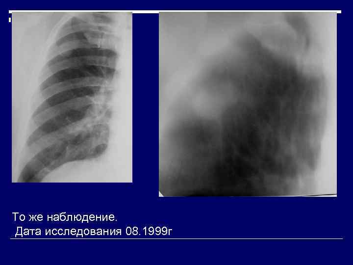 То же наблюдение.  Дата исследования 08. 1999 г 